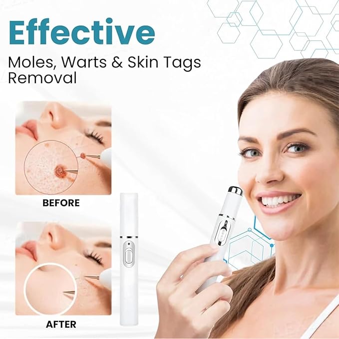 MOLE & WART REMOVAL LASER PEN